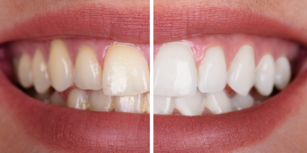How to Choose the Right Teeth Bleaching Dentist for Your Smile