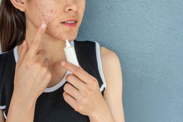 Understanding Active Acne and How to Treat It