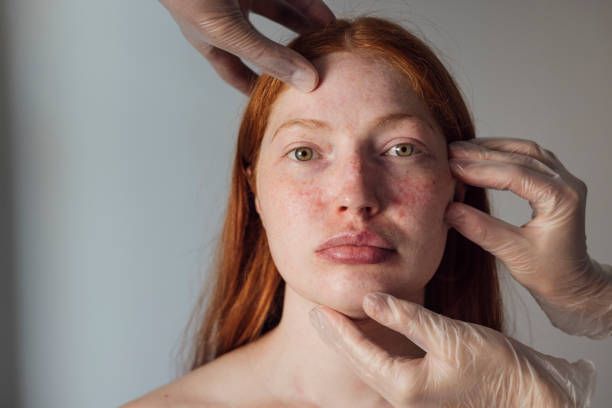 Best Treatments for Skin Pigment Discoloration in the UK